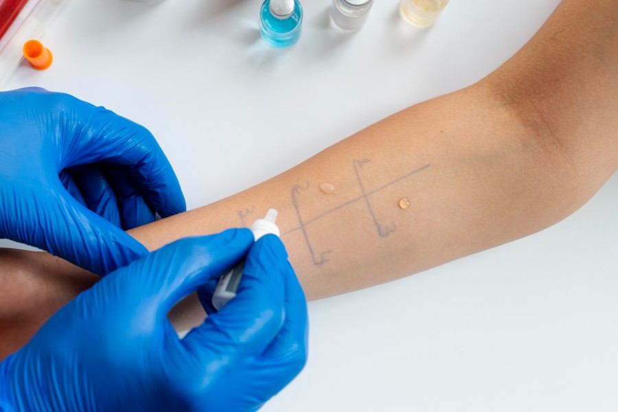Skin Allergy Testing